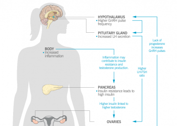 Anatomical figure of a woman. At the hypothalamus, there is a higher GnRH pulse frequency. At the pituitary gland, there is increased LH secretion. In the body, there is increased inflammation. In the pancreas, there is insulin resistance, leading to high insulin. In the ovaries, there is a lower progesterone-to-estrogen ratio, absent or irregular ovulation, increased testosterone, and excess ovarian follicles. An arrow shows that lack of progesterone from the ovaries contributes to higher GnRH pulse frequency.