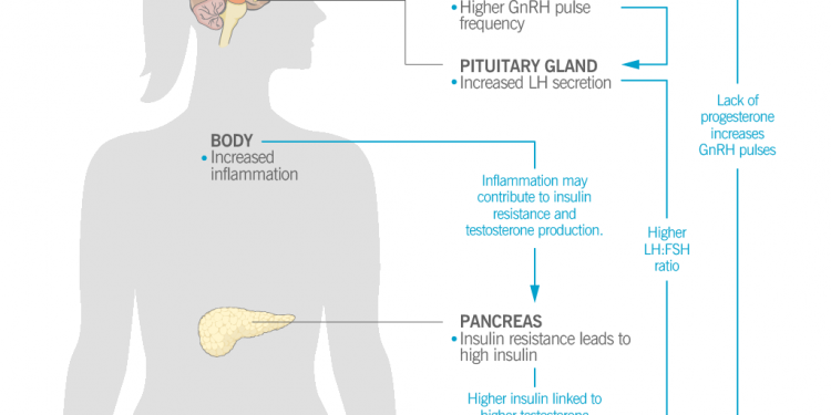 Anatomical figure of a woman. At the hypothalamus, there is a higher GnRH pulse frequency. At the pituitary gland, there is increased LH secretion. In the body, there is increased inflammation. In the pancreas, there is insulin resistance, leading to high insulin. In the ovaries, there is a lower progesterone-to-estrogen ratio, absent or irregular ovulation, increased testosterone, and excess ovarian follicles. An arrow shows that lack of progesterone from the ovaries contributes to higher GnRH pulse frequency.