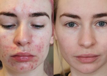 From Dry Skin to Depression: The Truth about Taking Roaccutane for Acne
