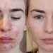From Dry Skin to Depression: The Truth about Taking Roaccutane for Acne