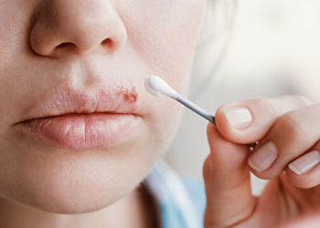 How To Get Rid Of Cold Sores