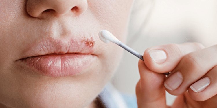 How To Get Rid Of Cold Sores